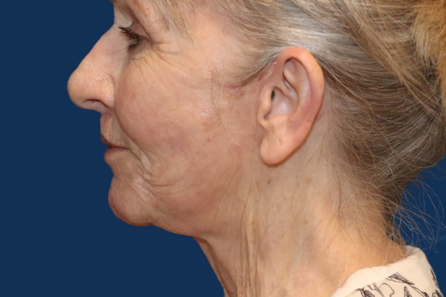 Facelift Before & After Gallery - Patient 335259 - Image 2