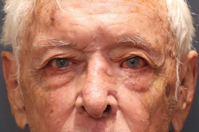Ptosis Repair Before & After Gallery - Patient 340291 - Image 4