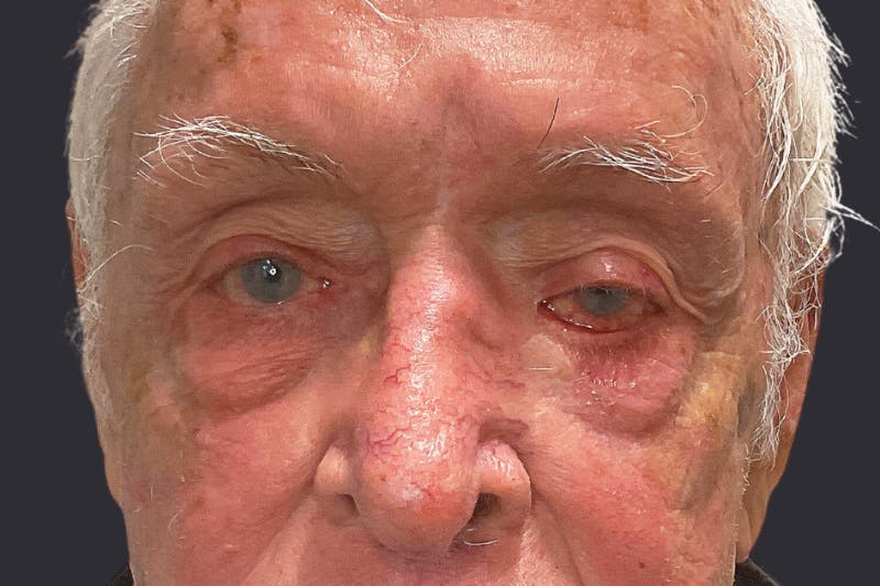 Ptosis Repair Before & After Gallery - Patient 340291 - Image 3