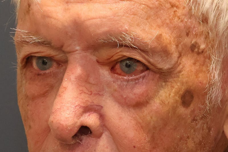 Ptosis Repair Before & After Gallery - Patient 340291 - Image 2