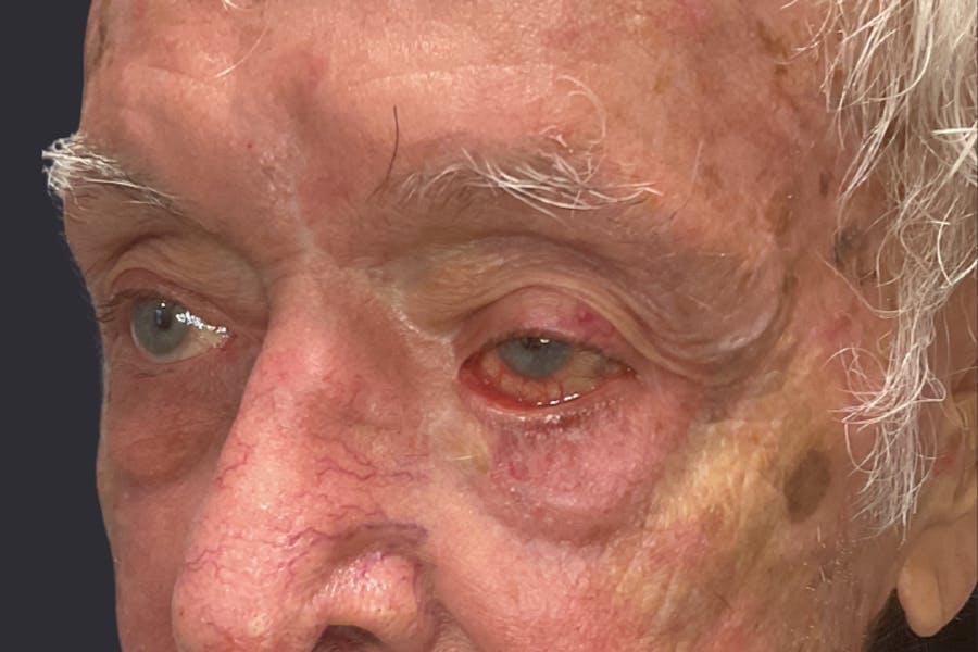 Ptosis Repair Before & After Gallery - Patient 340291 - Image 1