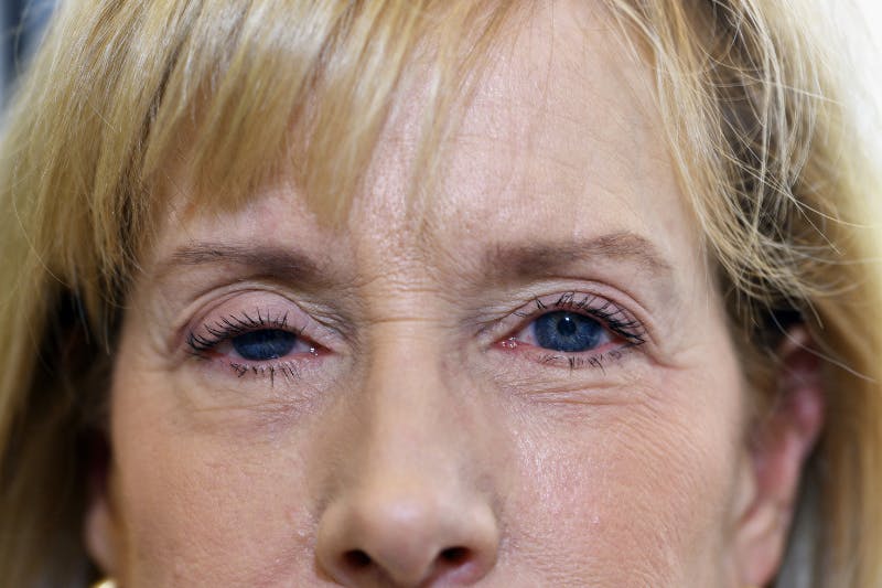 Ptosis Repair Before & After Gallery - Patient 123952 - Image 1