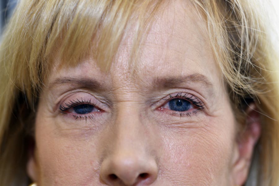 Ptosis Repair Before & After Gallery - Patient 123952 - Image 1