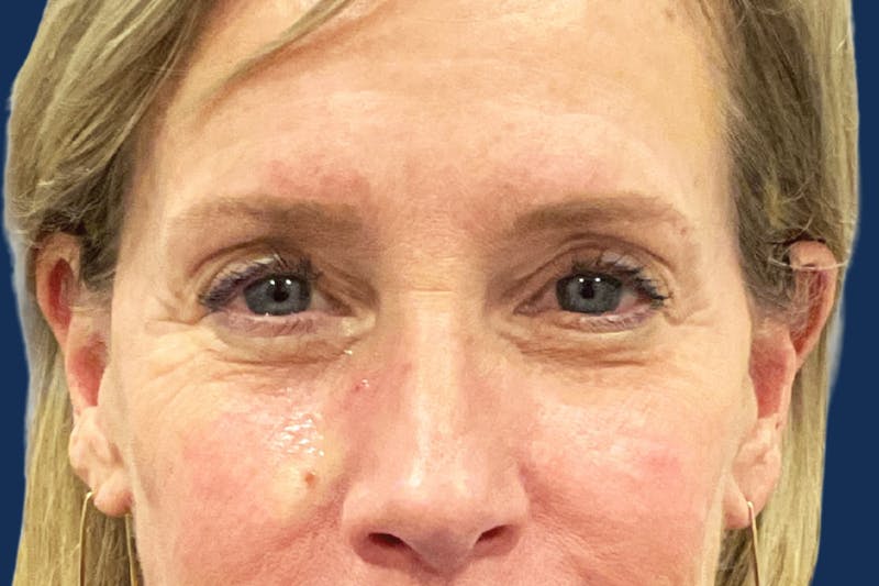 Ptosis Repair Before & After Gallery - Patient 123952 - Image 2