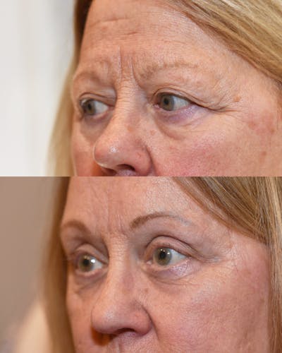 Endoscopic Brow Lift with Upper Blepharoplasty Before & After Gallery - Patient 371955 - Image 1