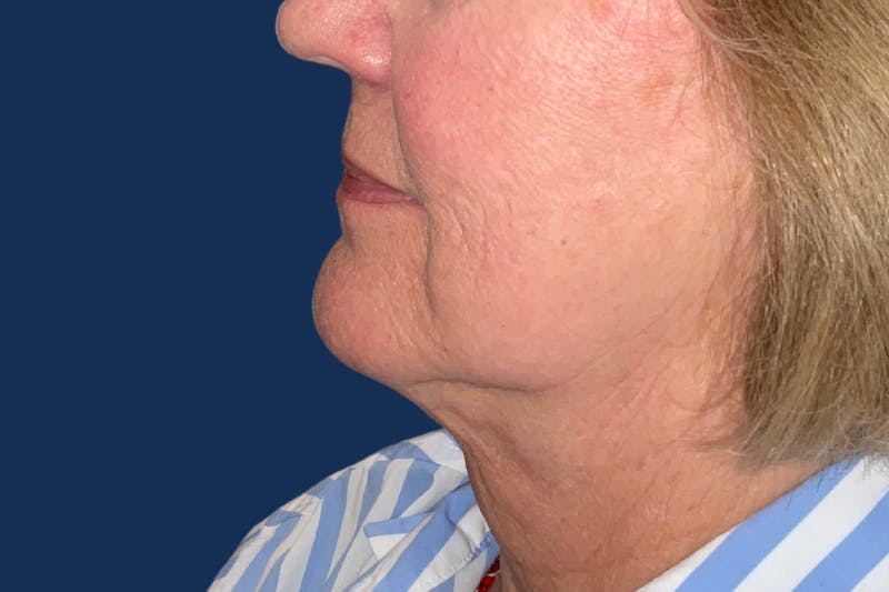 Platysmalplasty Before & After Gallery - Patient 269219 - Image 2