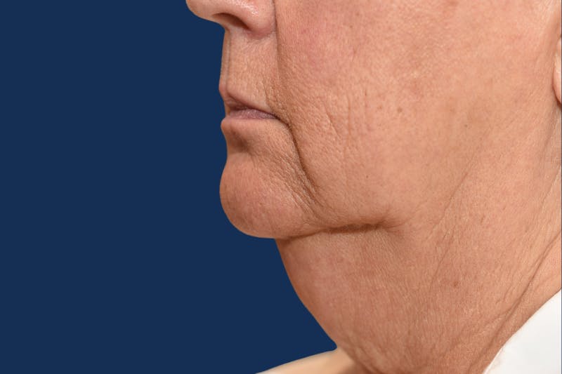 Platysmalplasty Before & After Gallery - Patient 269219 - Image 1