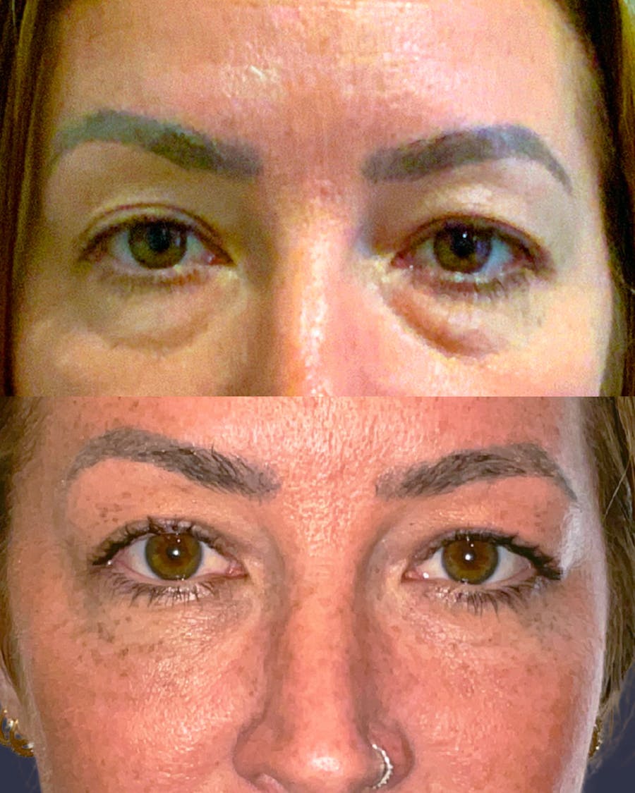 Lower Blepharoplasty Before & After Gallery - Patient 432907 - Image 1