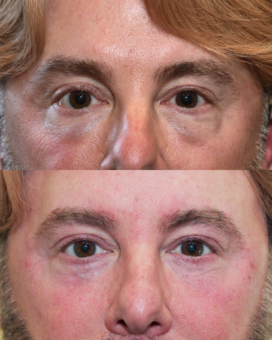 Lower Blepharoplasty Before & After Gallery - Patient 340475 - Image 1