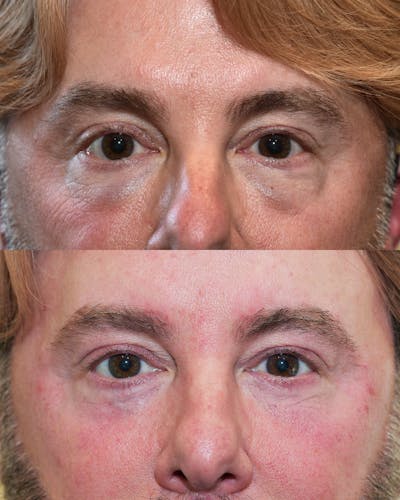 Facial Implants Before & After Gallery - Patient 338576 - Image 1