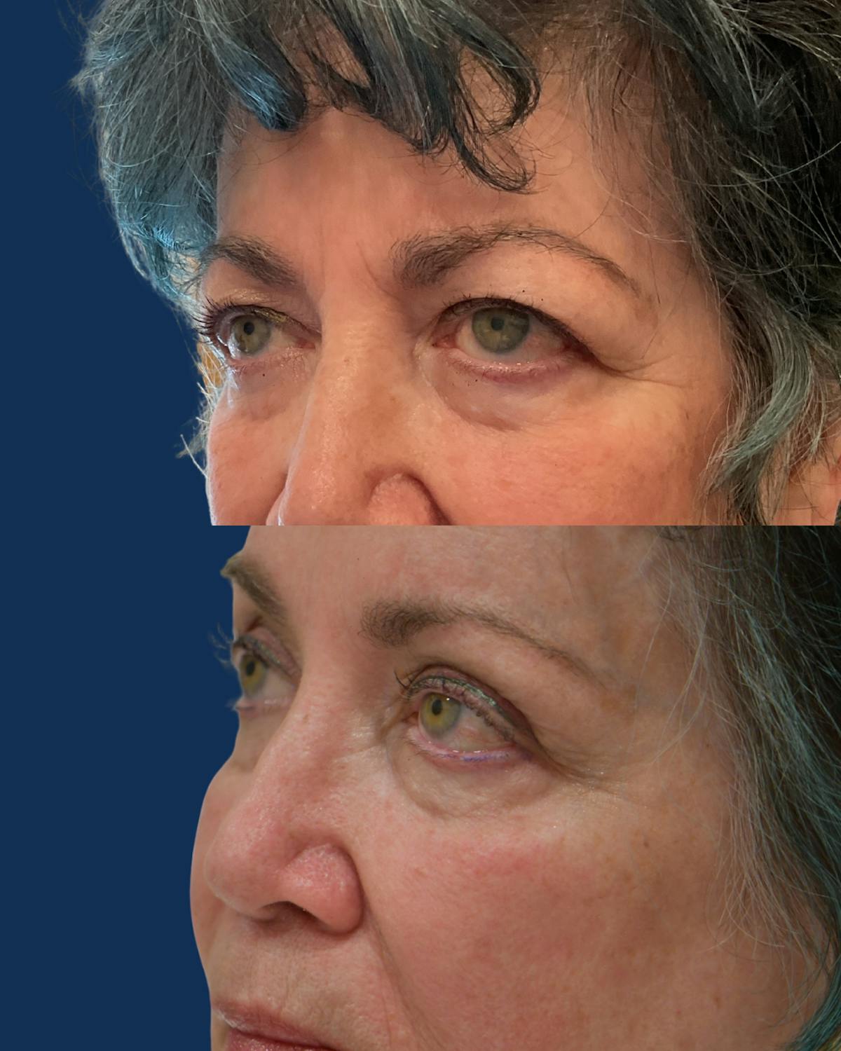Endoscopic Brow Lift with Upper Blepharoplasty Before & After Gallery - Patient 191472 - Image 2