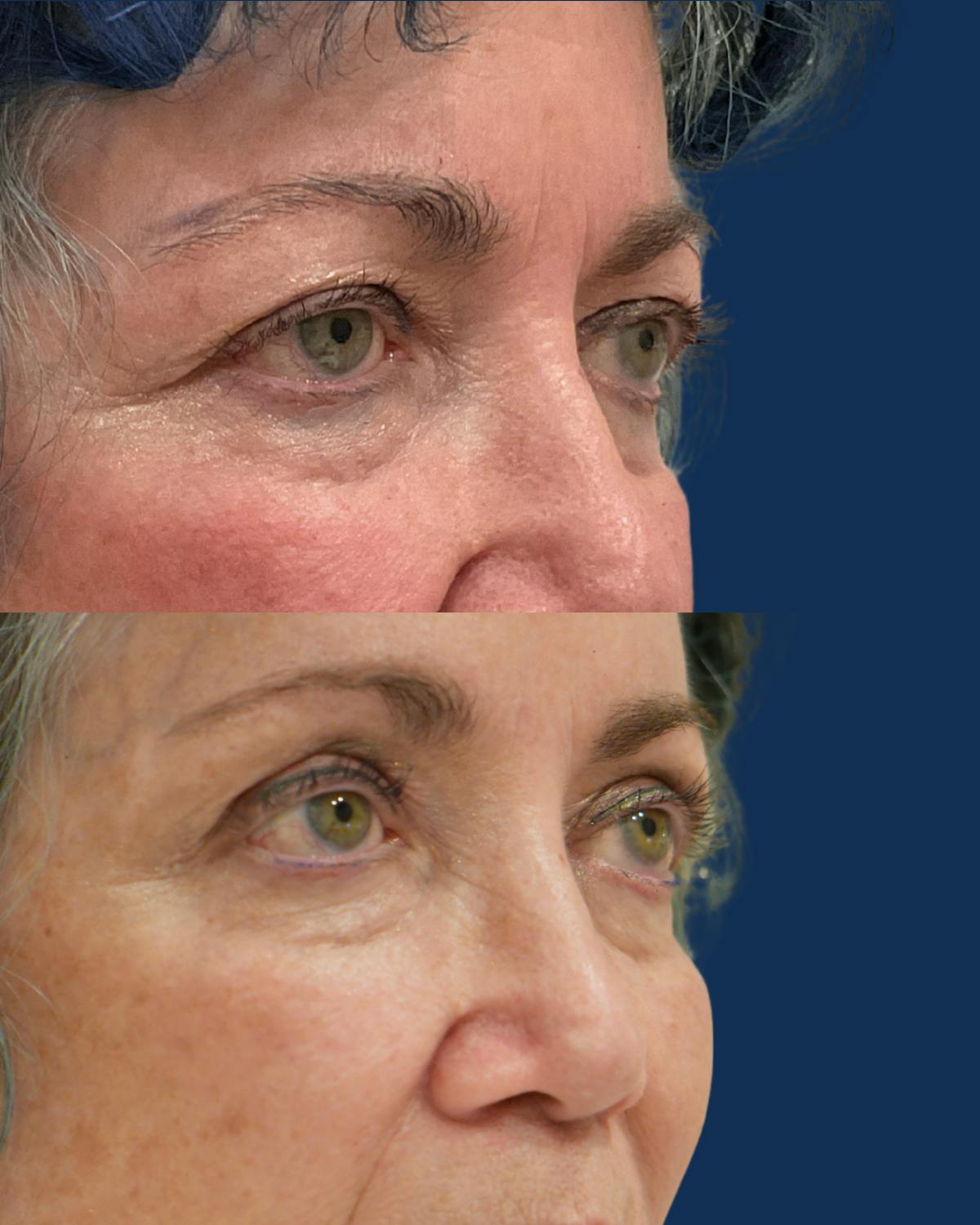 Endoscopic Brow Lift with Upper Blepharoplasty Before & After Gallery - Patient 191472 - Image 3