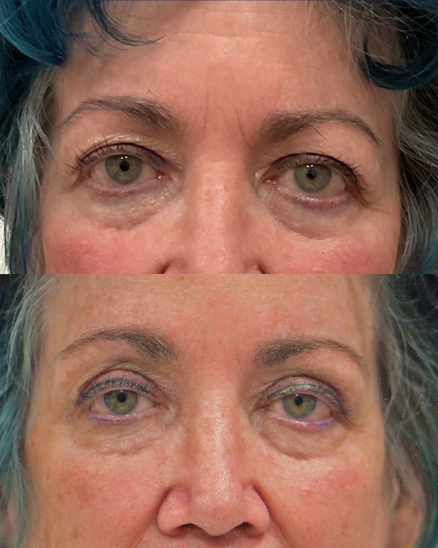 Endoscopic Brow Lift with Upper Blepharoplasty Before & After Gallery - Patient 191472 - Image 1