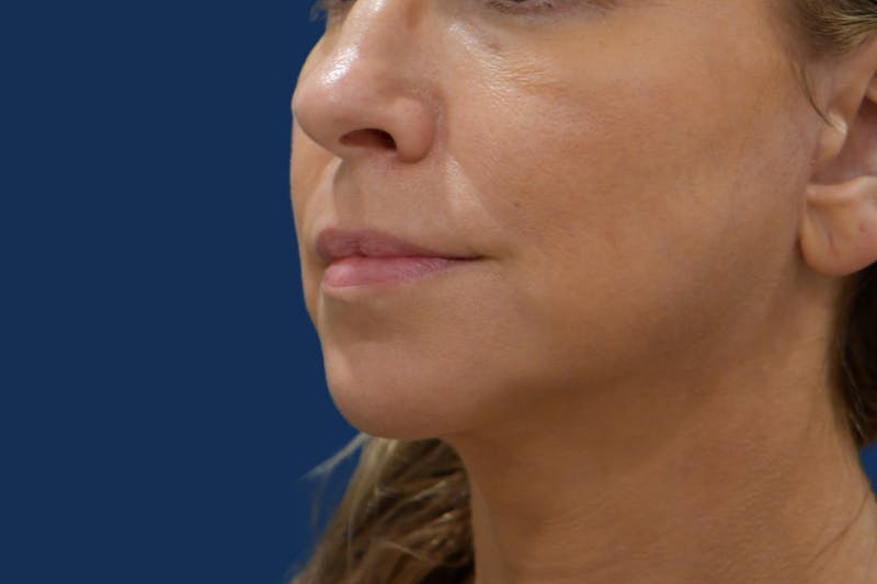 Platysmalplasty Before & After Gallery - Patient 262855 - Image 2