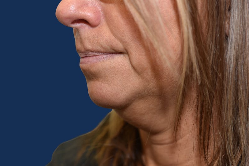 Platysmalplasty Before & After Gallery - Patient 262855 - Image 1