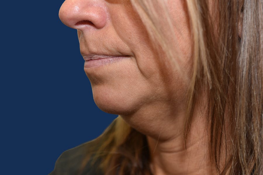 Platysmalplasty Before & After Gallery - Patient 262855 - Image 1