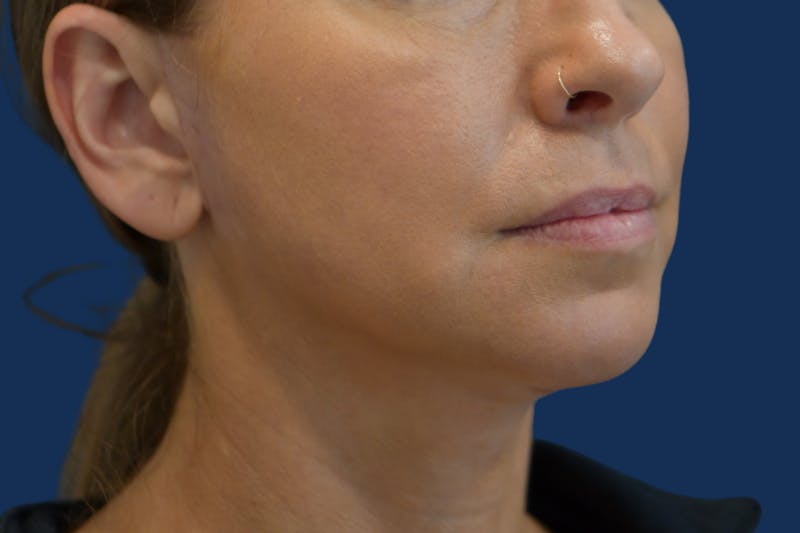 Platysmalplasty Before & After Gallery - Patient 262855 - Image 4