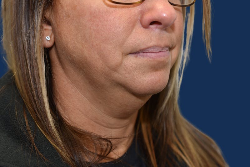 Platysmalplasty Before & After Gallery - Patient 262855 - Image 3