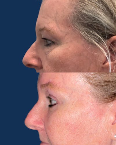 Endoscopic Brow Lift with Upper Blepharoplasty Before & After Gallery - Patient 349038 - Image 1