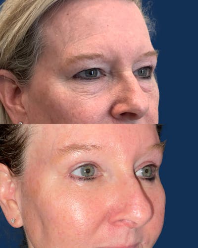 Facial Implants Before & After Gallery - Patient 191722 - Image 1