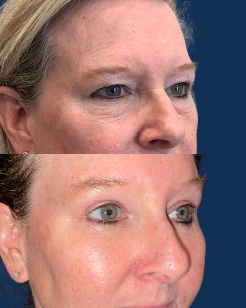 Facial Implants Before & After Gallery - Patient 191722 - Image 1