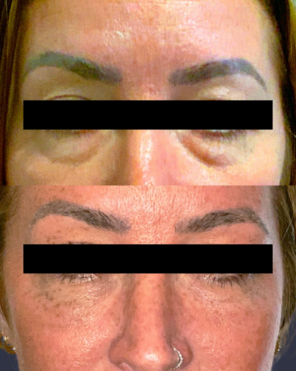 Lower Blepharoplasty Before & After Gallery - Patient 392844 - Image 1