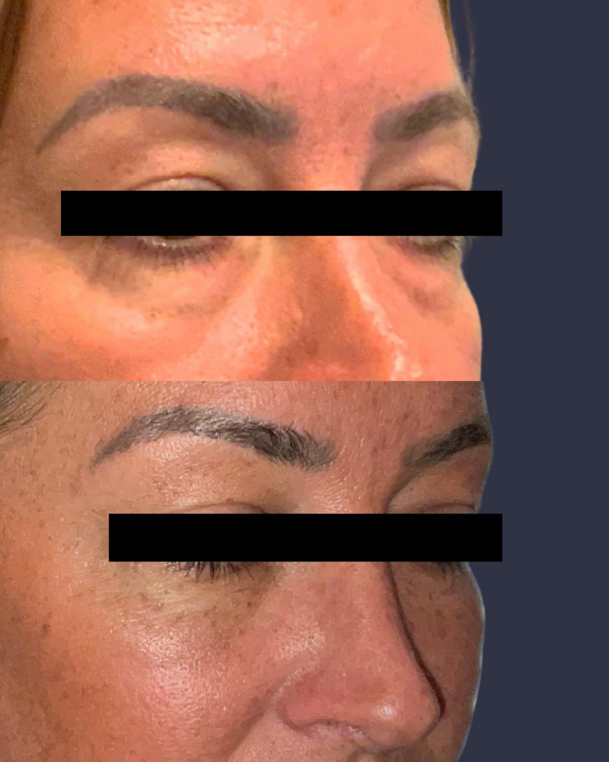 Lower Blepharoplasty Before & After Gallery - Patient 392844 - Image 2