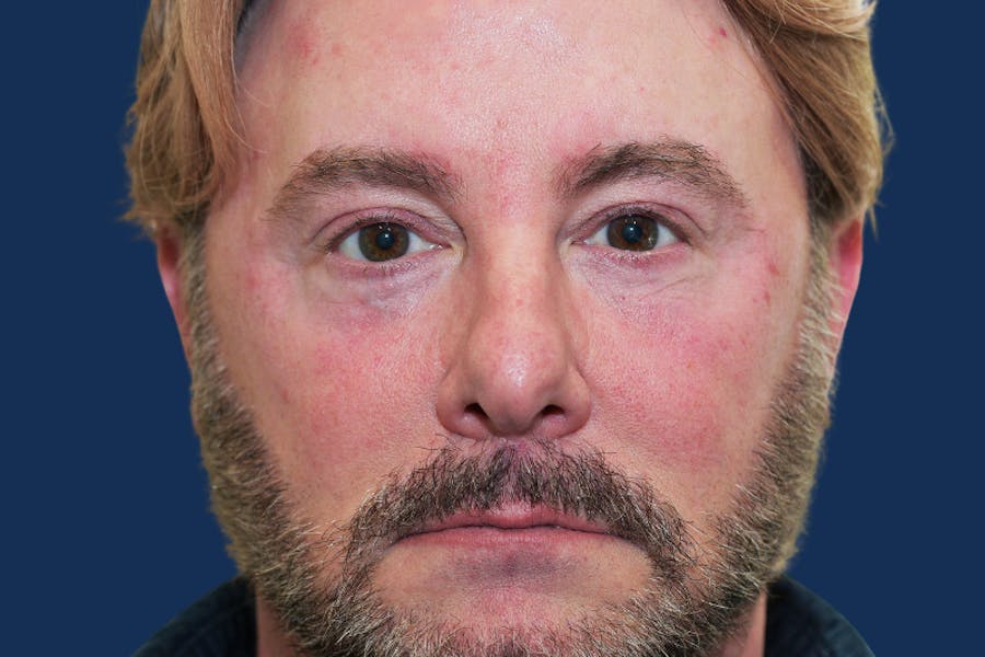 CO2 Laser Resurfacing Before & After Gallery - Patient 401885 - Image 2