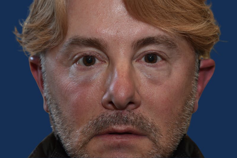 CO2 Laser Resurfacing Before & After Gallery - Patient 401885 - Image 1