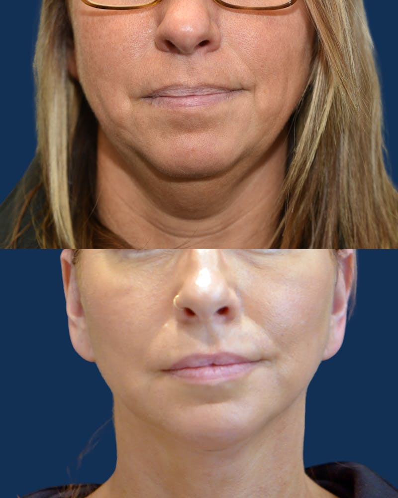 Fillers Before & After Gallery - Patient 294457 - Image 1