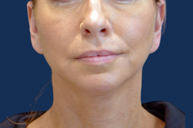Platysmalplasty Before & After Gallery - Patient 262855 - Image 6
