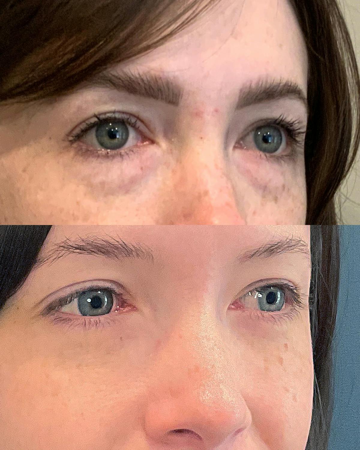 Lower Blepharoplasty Before & After Gallery - Patient 178276 - Image 2