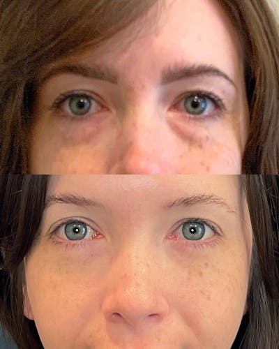 Lower Blepharoplasty Before & After Gallery - Patient 178276 - Image 1