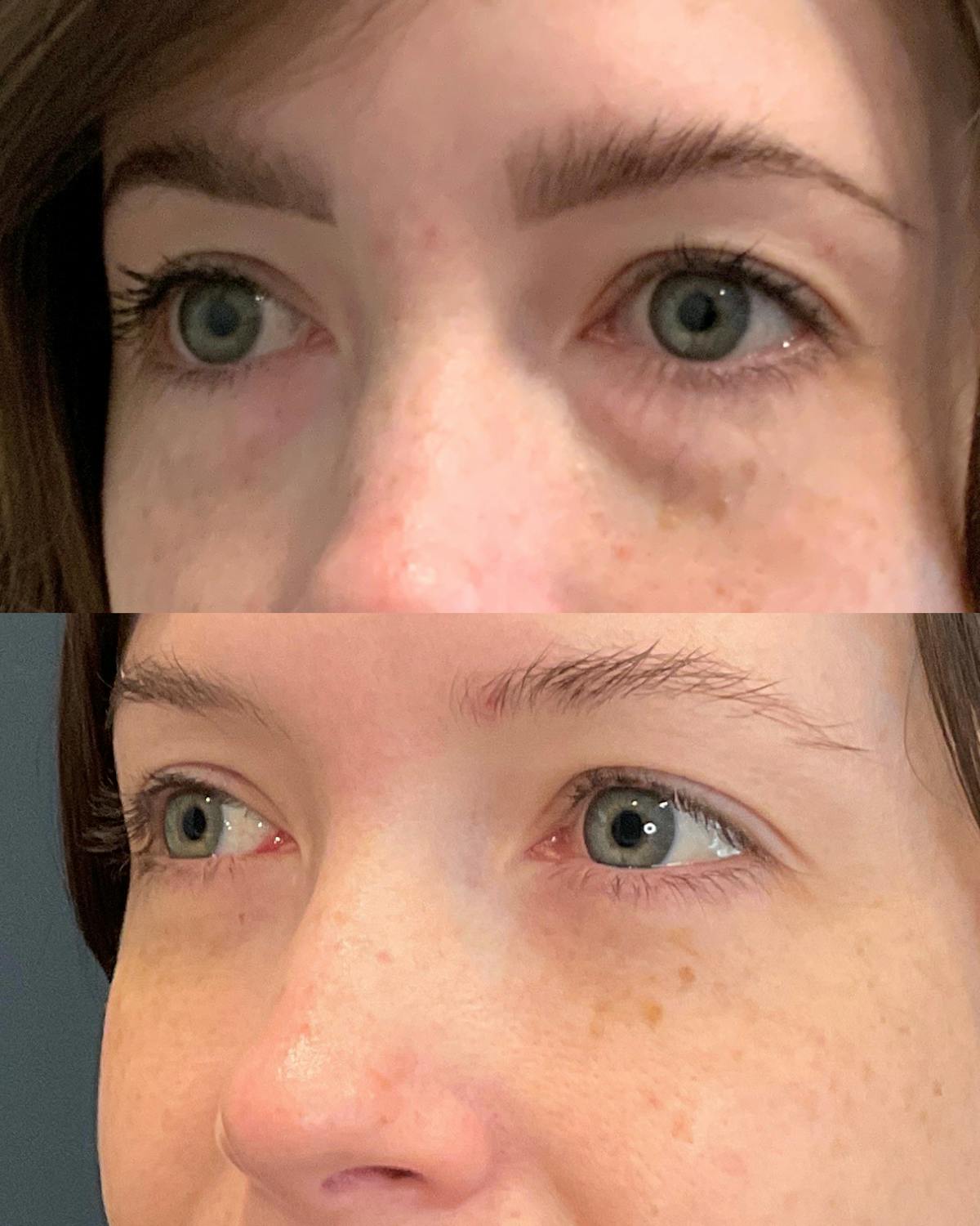 Lower Blepharoplasty Before & After Gallery - Patient 178276 - Image 3