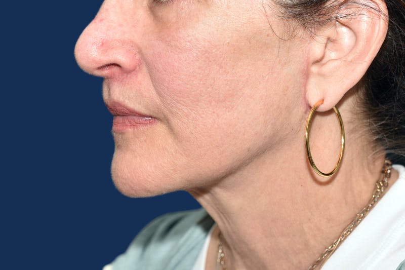 Submental Lipo Before & After Gallery - Patient 379006 - Image 2