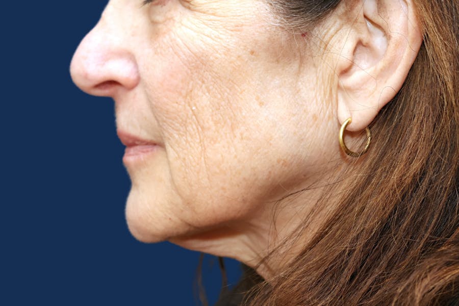 Platysmalplasty Before & After Gallery - Patient 377455 - Image 1