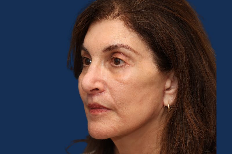Full Facial Rejuvenation Before & After Gallery - Patient 103613 - Image 2