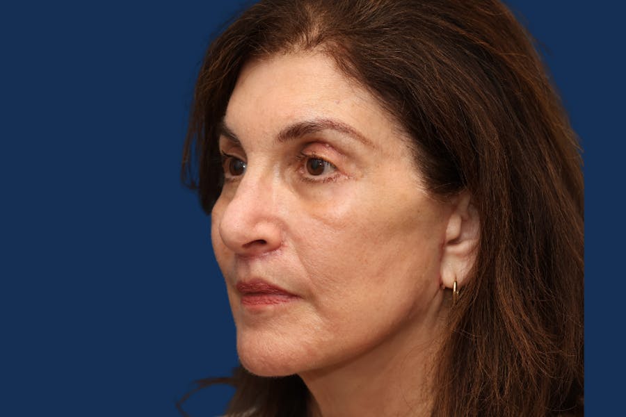 Full Facial Rejuvenation Before & After Gallery - Patient 103613 - Image 2