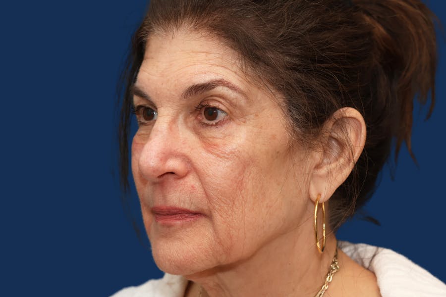 Full Facial Rejuvenation Before & After Gallery - Patient 103613 - Image 1
