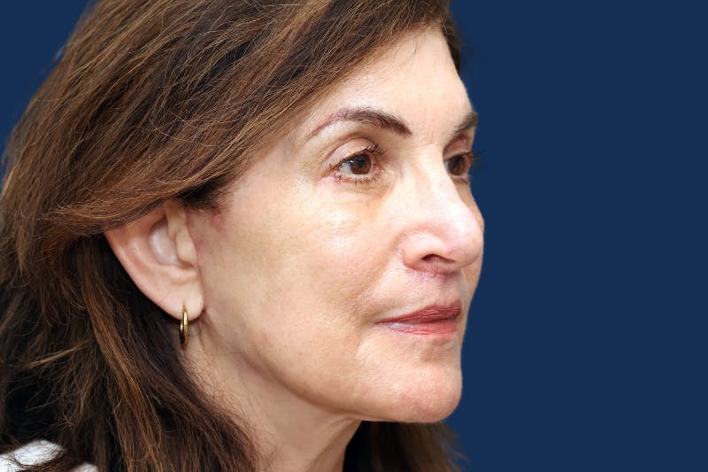 Full Facial Rejuvenation Before & After Gallery - Patient 103613 - Image 6