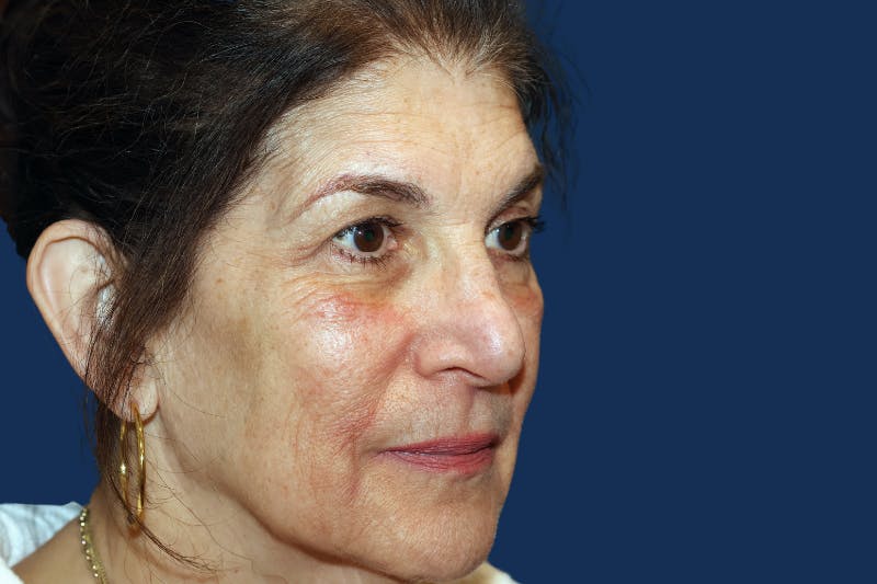Full Facial Rejuvenation Before & After Gallery - Patient 103613 - Image 5