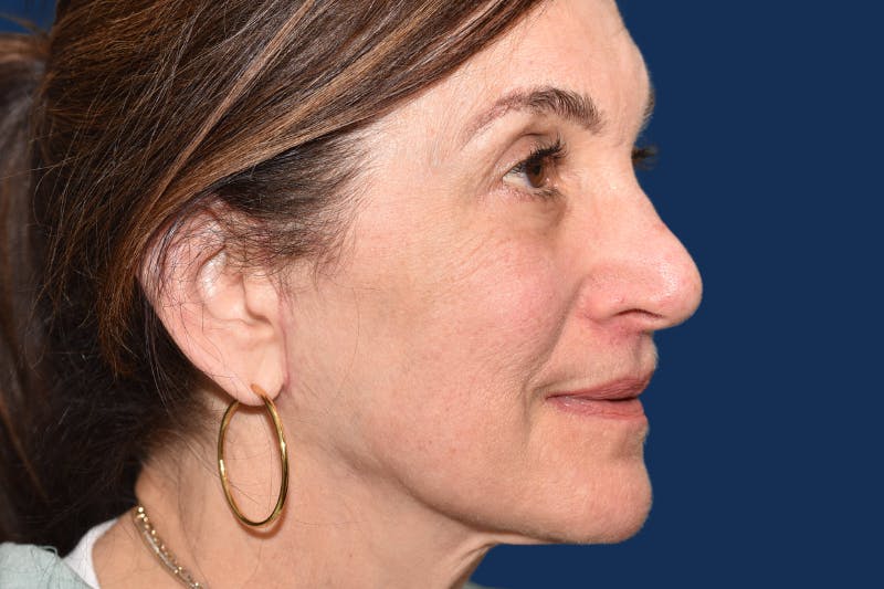Full Facial Rejuvenation Before & After Gallery - Patient 103613 - Image 4