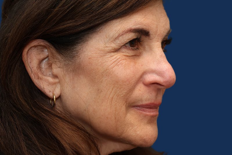 Full Facial Rejuvenation Before & After Gallery - Patient 103613 - Image 3