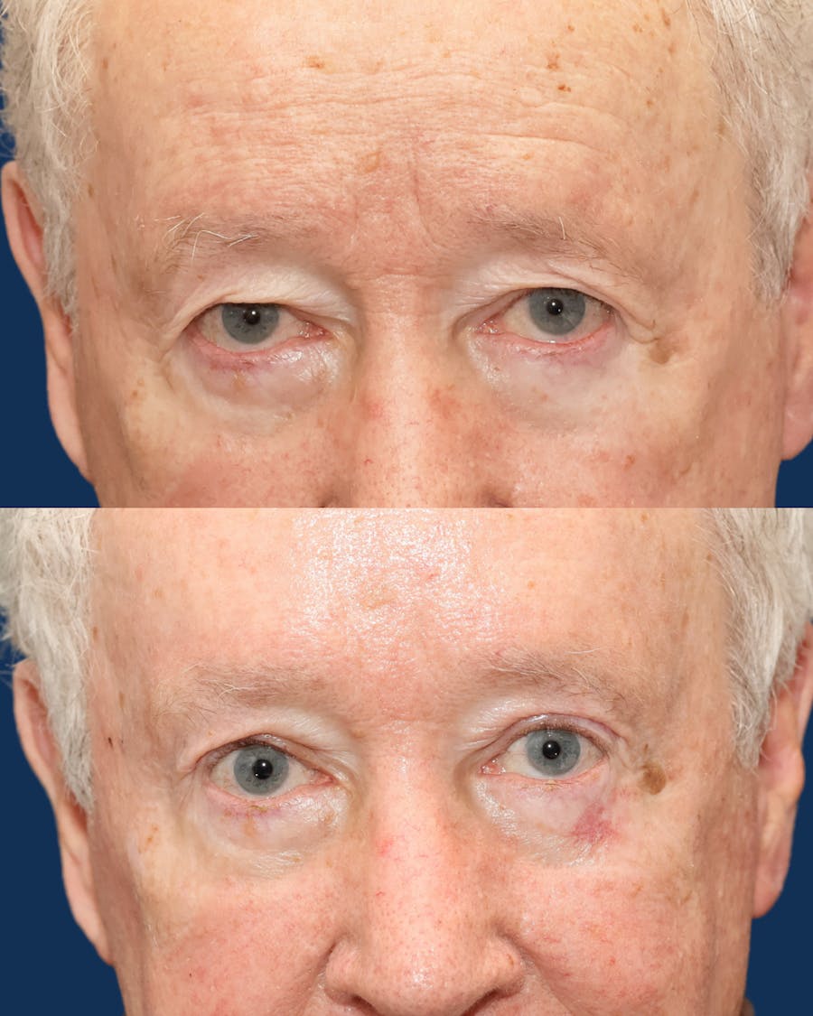Endoscopic Brow Lift with Upper Blepharoplasty Before & After Gallery - Patient 304665 - Image 1