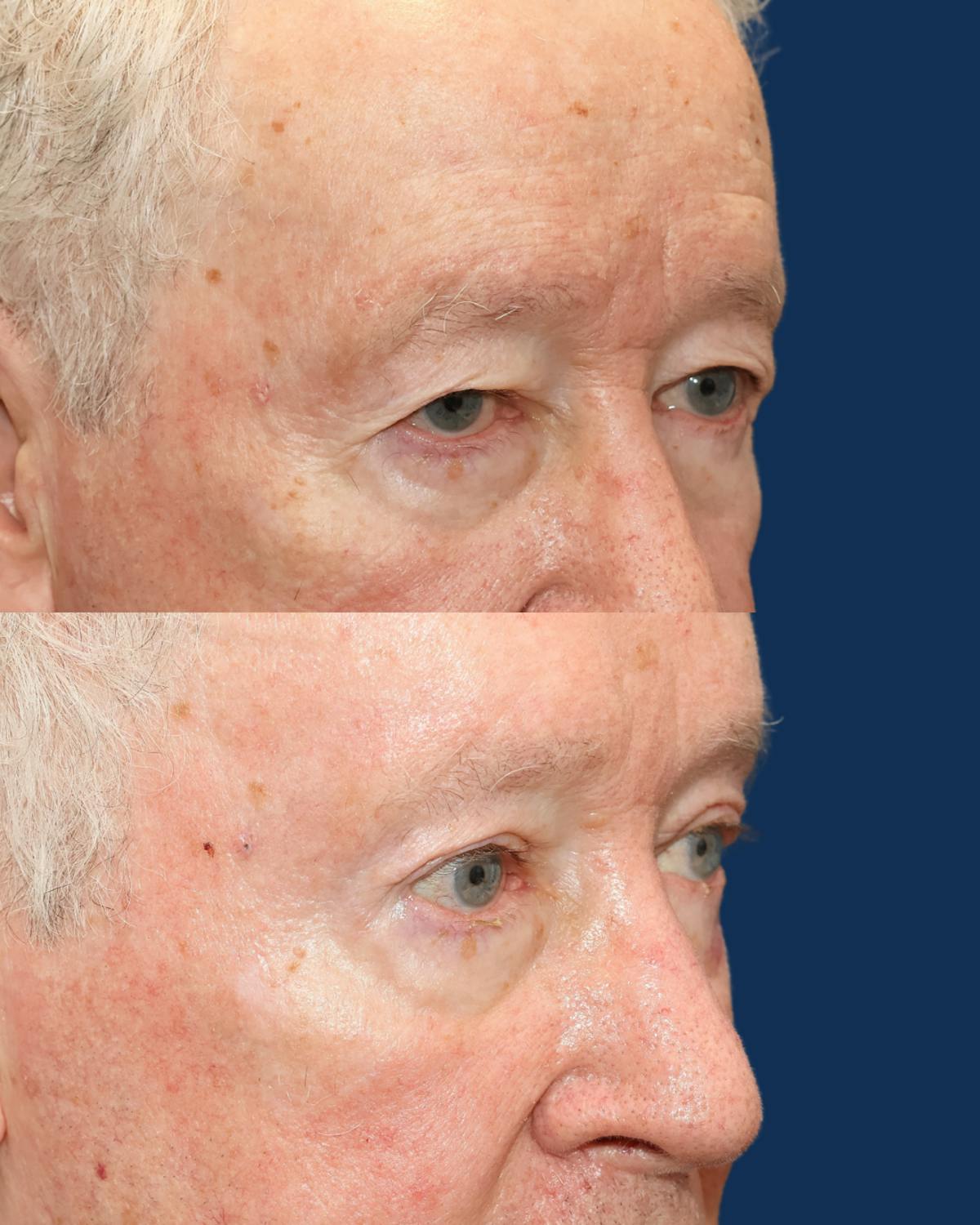 Endoscopic Brow Lift with Upper Blepharoplasty Before & After Gallery - Patient 304665 - Image 2
