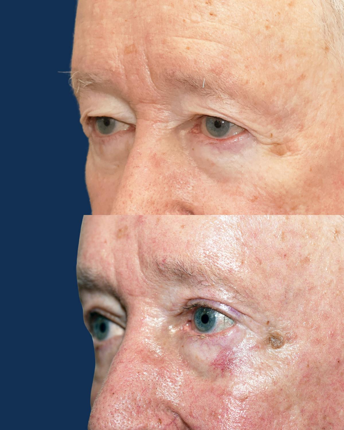 Endoscopic Brow Lift with Upper Blepharoplasty Before & After Gallery - Patient 304665 - Image 3