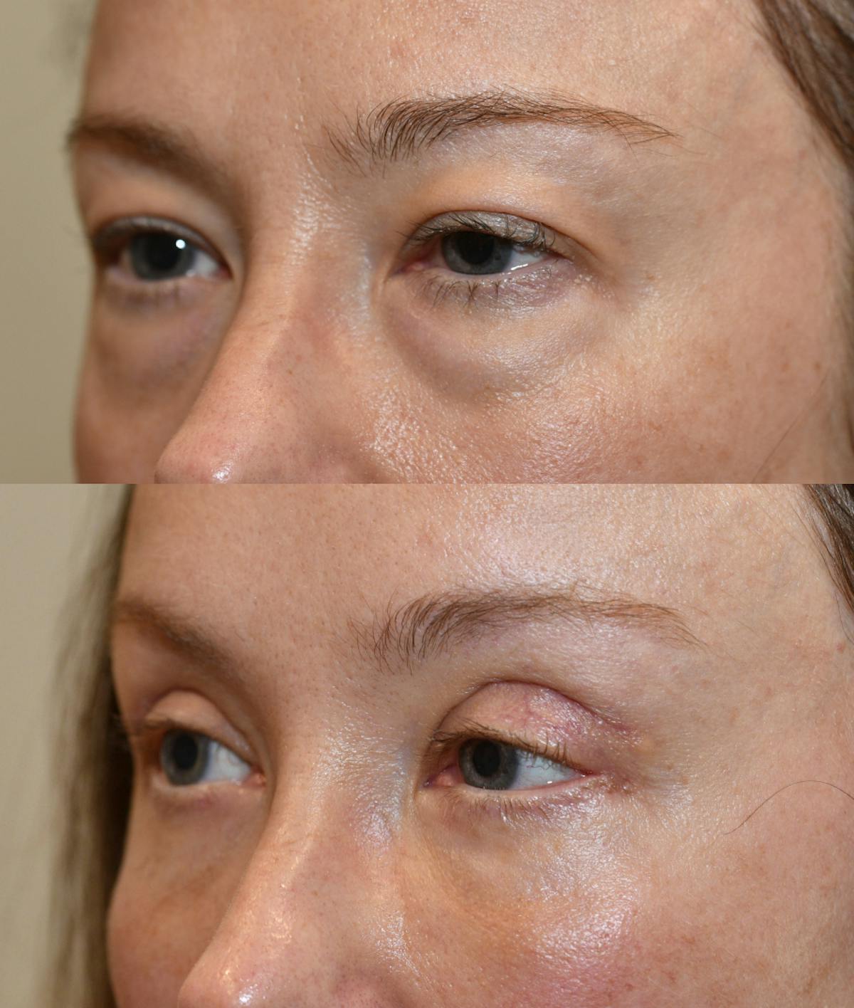 Facial Implants Before & After Gallery - Patient 788153 - Image 3