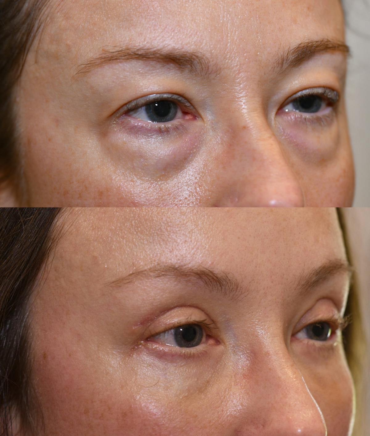 Facial Implants Before & After Gallery - Patient 788153 - Image 2