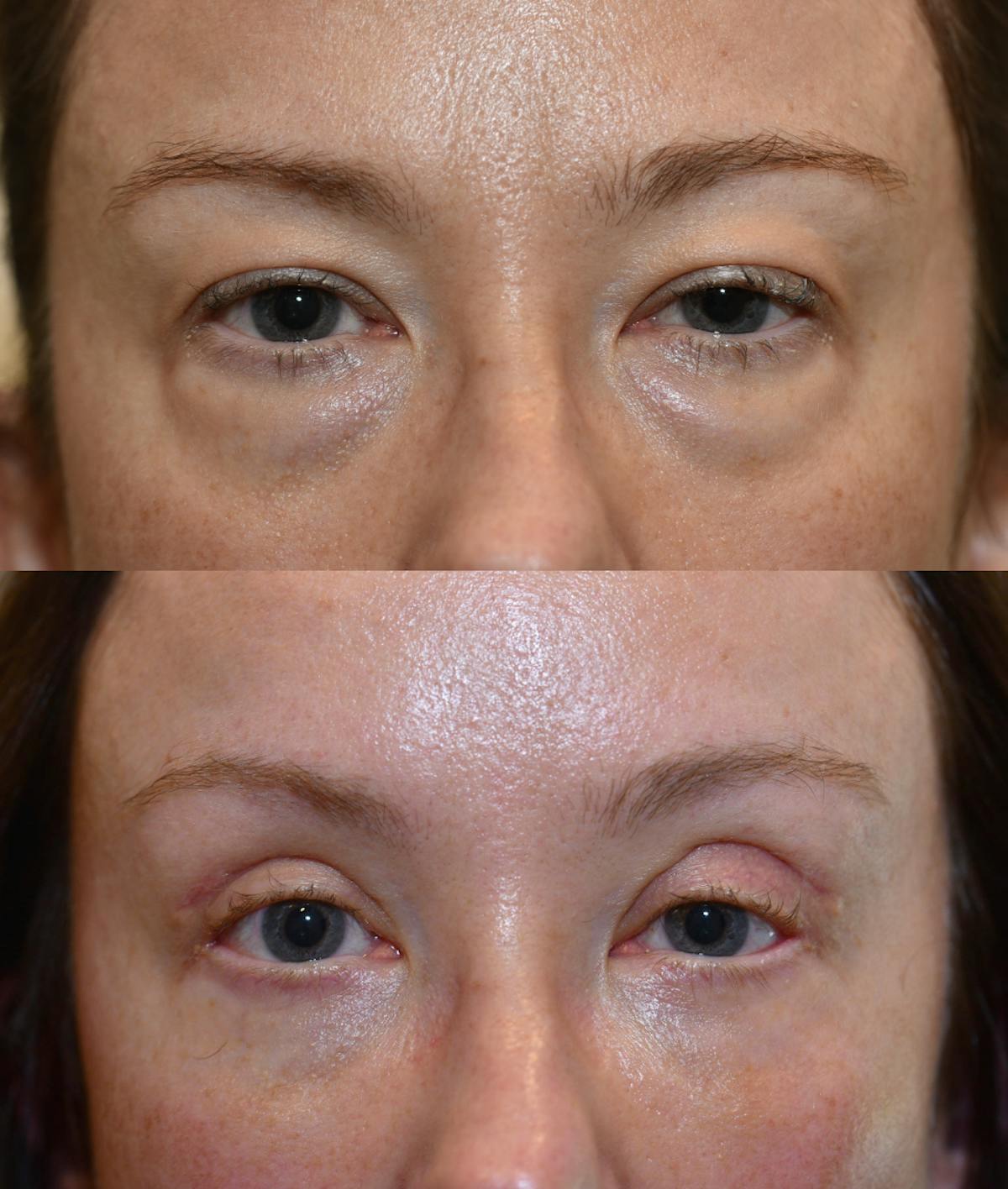 Facial Implants Before & After Gallery - Patient 788153 - Image 1