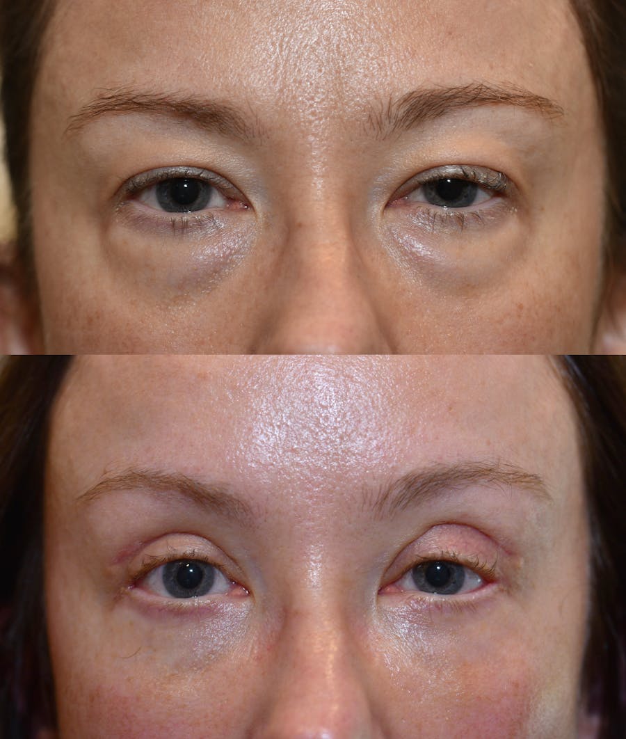 Lower Blepharoplasty Before & After Gallery - Patient 309053 - Image 1
